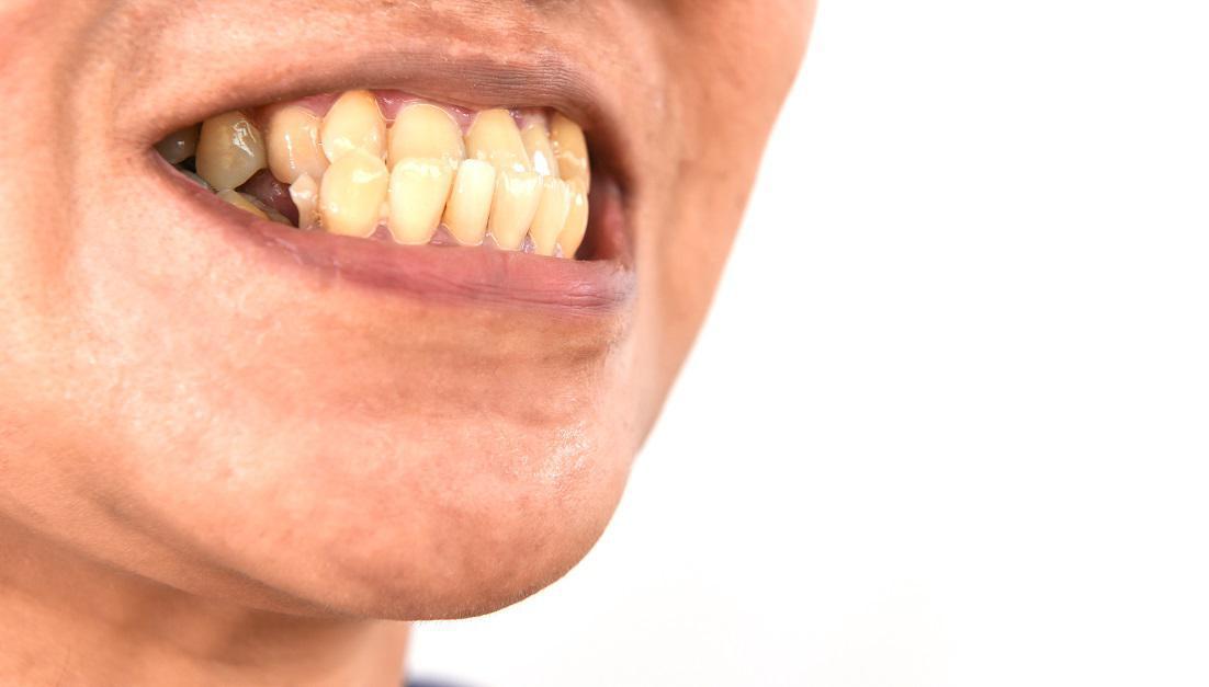 What Happens When You Have An Underbite?
