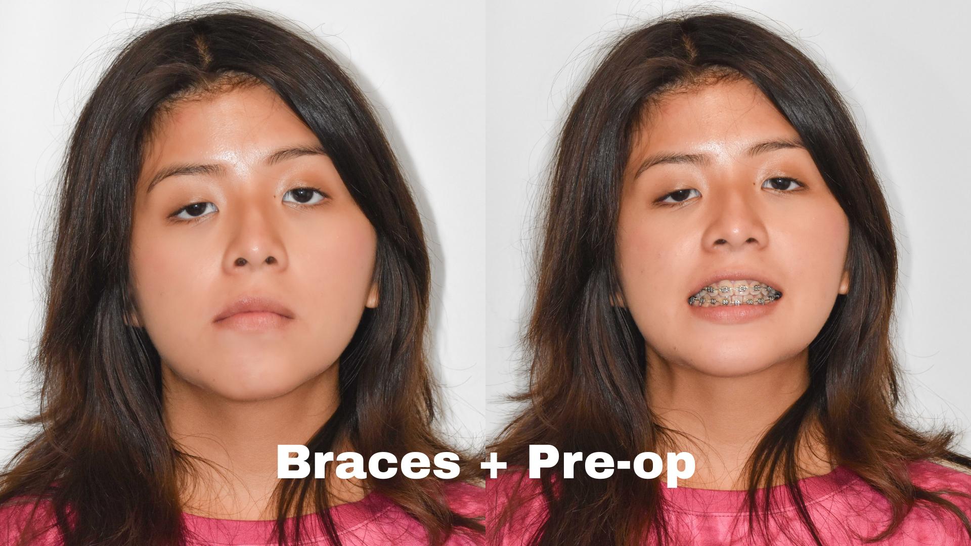 before and after facial surgery and orthodontics at Elite Orthodontics