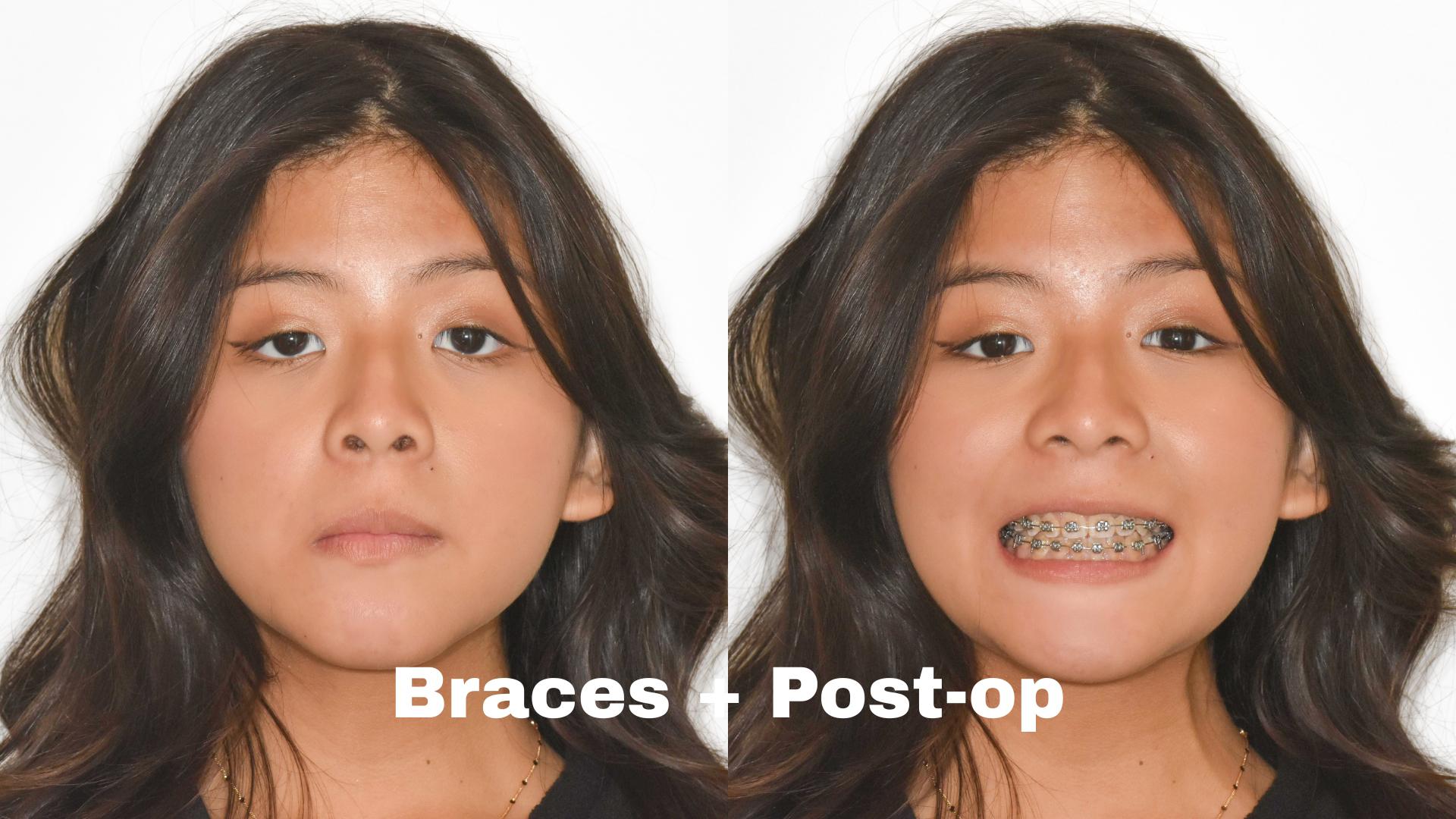 post operation surgery for orthodontics in Northern Virginia