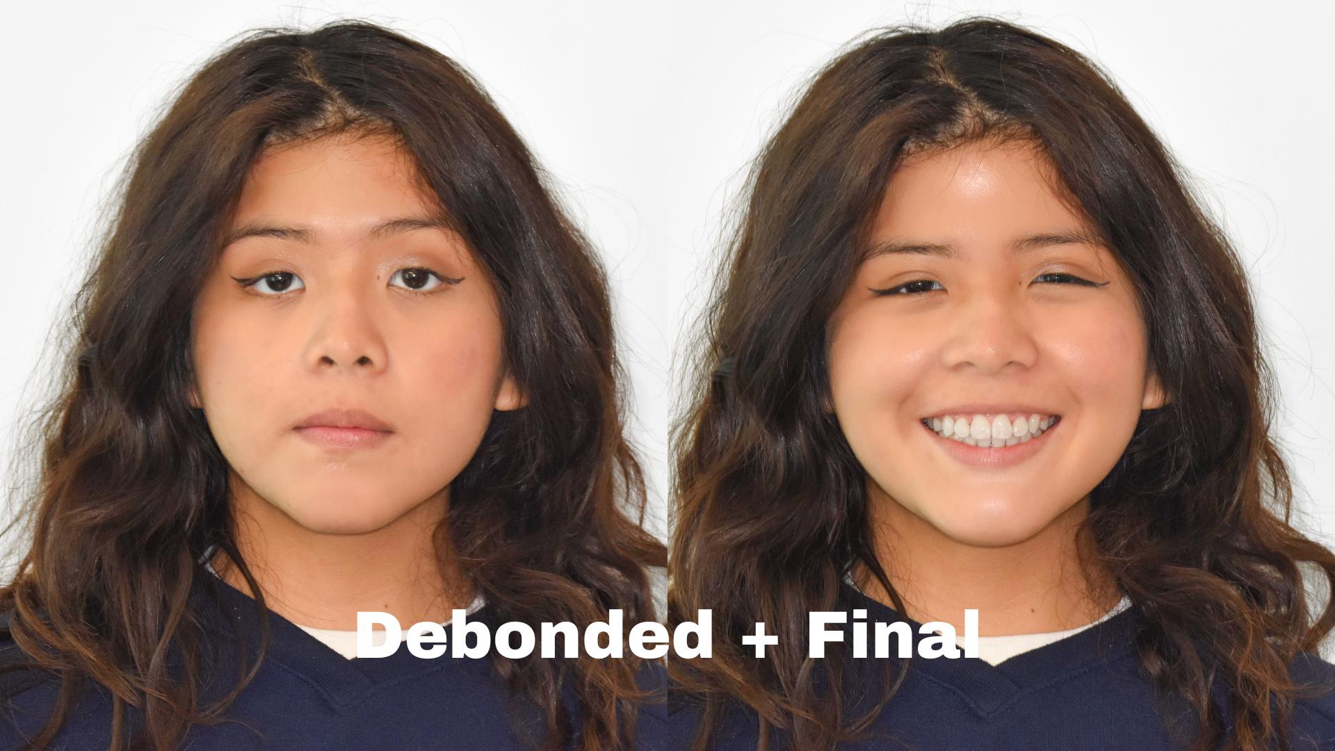 beautiful smile after facial orthodontic surgery near Falls Church