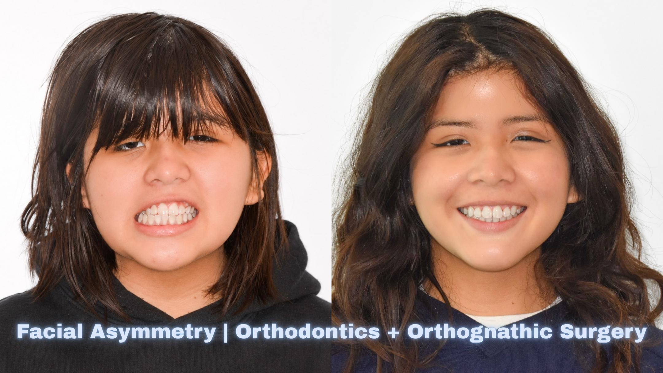 before and after image of patient with Canted Smile & Facial Asymmetry Treatment