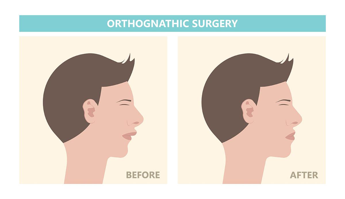 infographic depicting before and after Orthognathic jaw surgery procedure