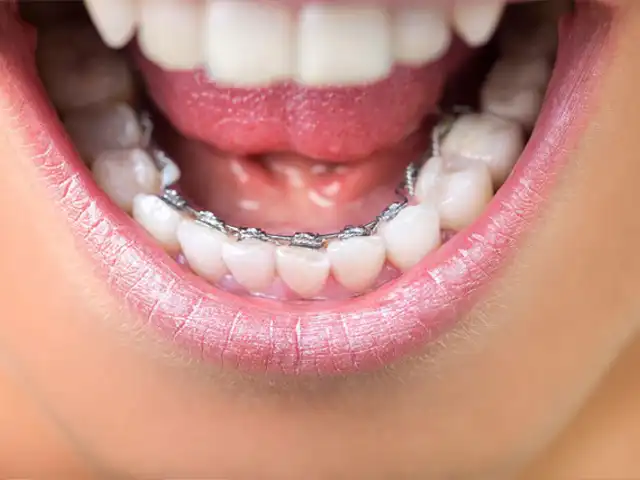 What You Need to Know About Lingual Braces - Brimhall Dental Group