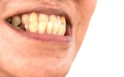 What Happens When You Have An Underbite?