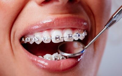 When Traditional Metal Braces Shine: Navigating Your Orthodontic Options